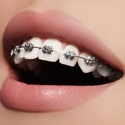 Melyik a legjobb fogszabályozó készülék?