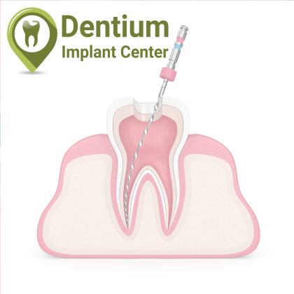 Root canal treatment